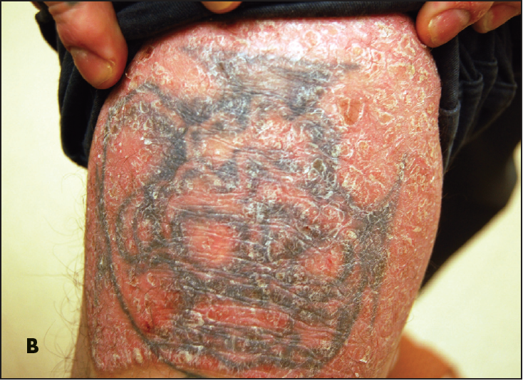 Chronic Plaque Psoriasis Consultant360